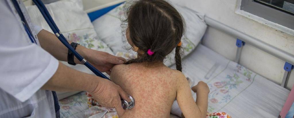 Sarampión: dan por finalizado el brote en la Provincia