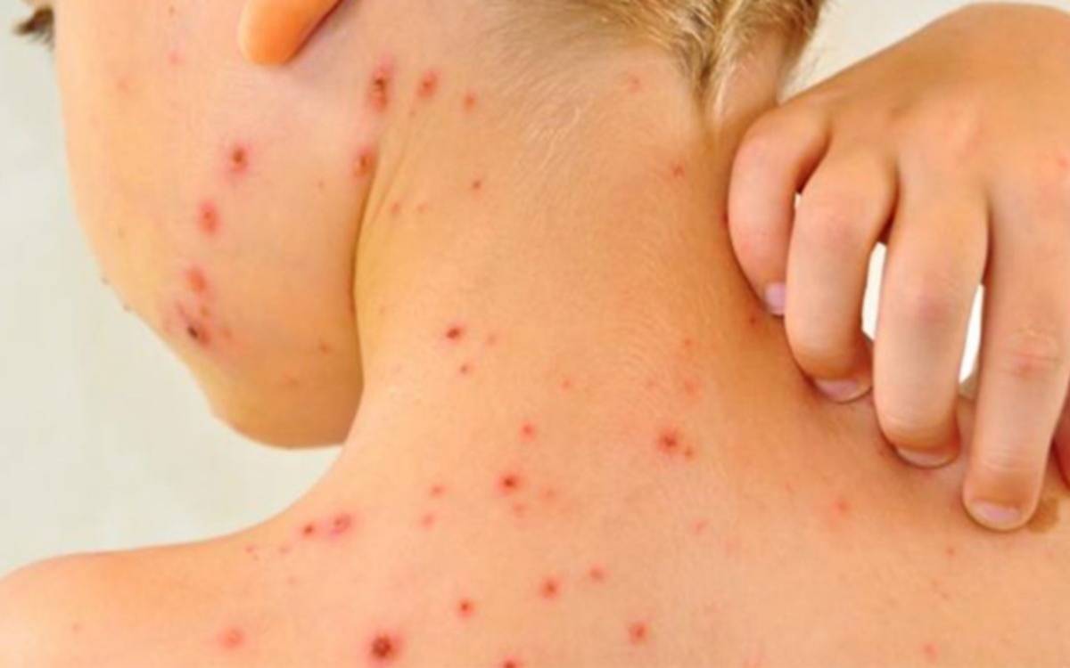 Alerta en Entre Ríos por posible exposición de pasajeros al sarampión