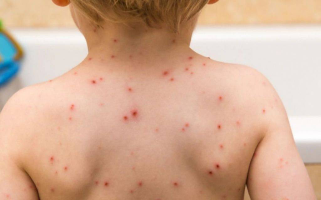 Un brote de sarampión enciende alarmas en la Provincia: los síntomas y cómo se contagia