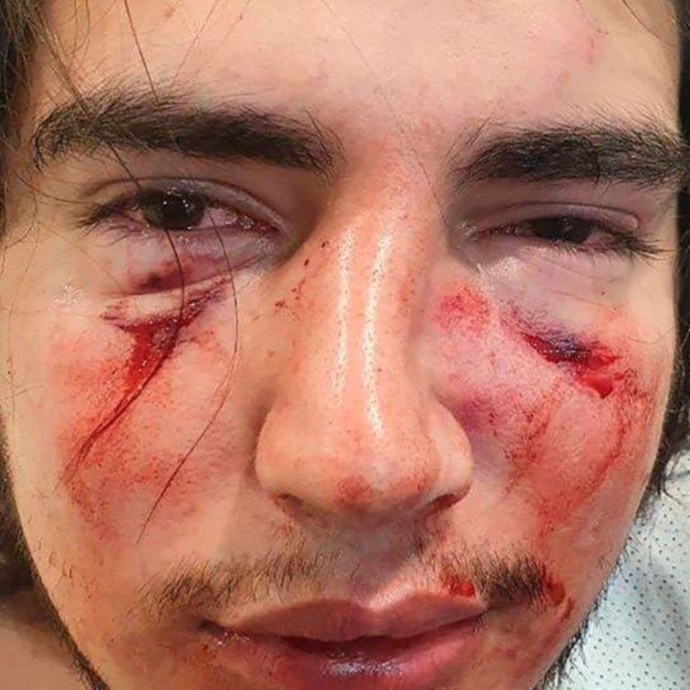 Denuncian a cuatro rugbiers por "lesiones graves" en brutal golpiza a un joven en Córdoba