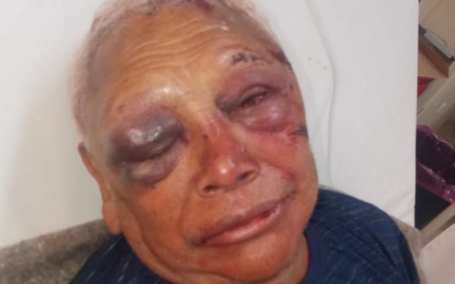 Salvaje robo a un jubilado en La Plata: lo golpearon y terminó con el rostro desfigurado