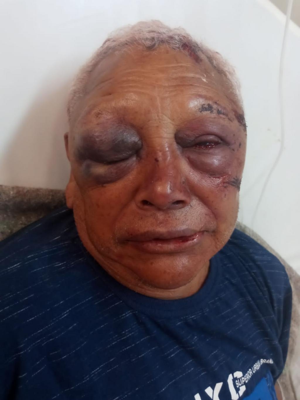 Salvaje asalto a un jubilado: le desfiguraron la cara a golpes en Sicardi