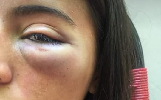Denunció que un hombre la noqueó y desfiguró en una fiesta de egresados en La Plata