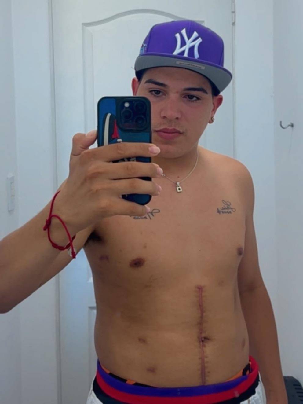 Thiago desfiló sus cicatrices: “Gracias a ellas sigo vivo”