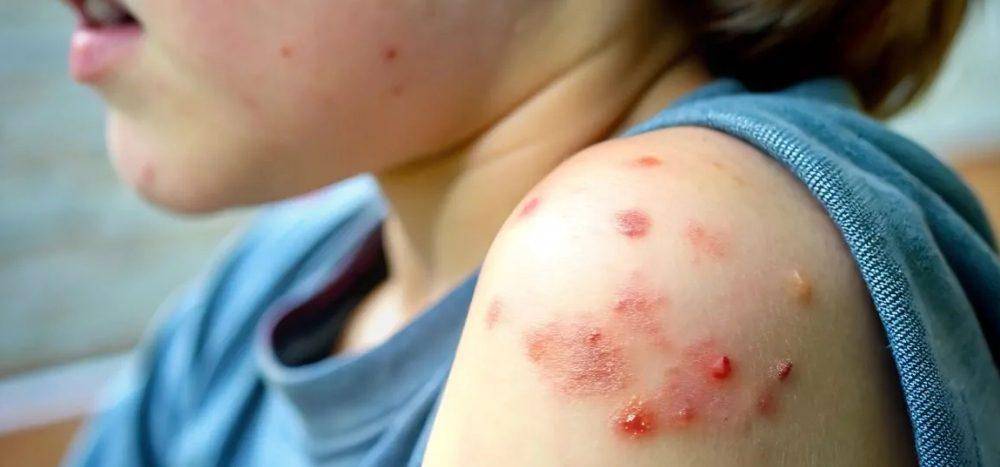 Doctors also share the concerns about a lack of vaccinations