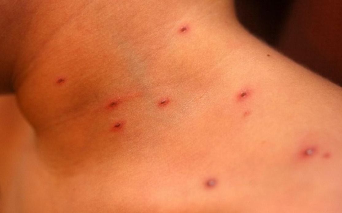 Se desconoce aún si la beba atendida en la Clínica del Niño tuvo sarampión