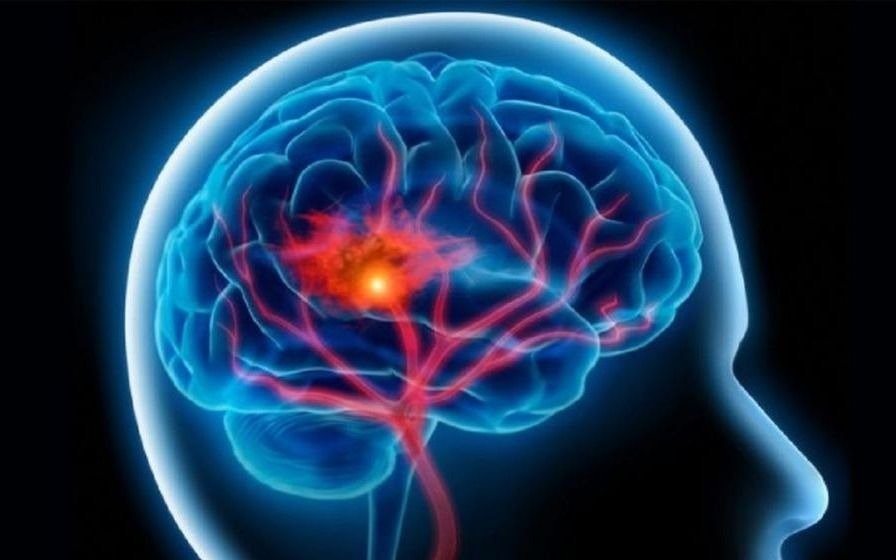 La prevención de accidentes cerebro vasculares