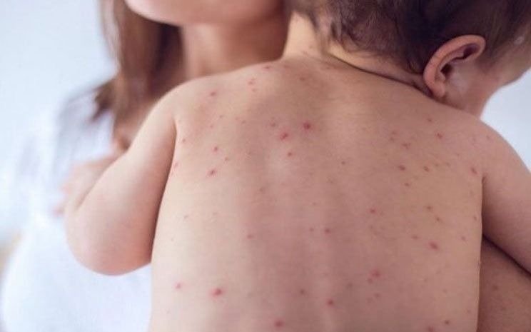 Ya llegan a 55 los casos de sarampión en el país
