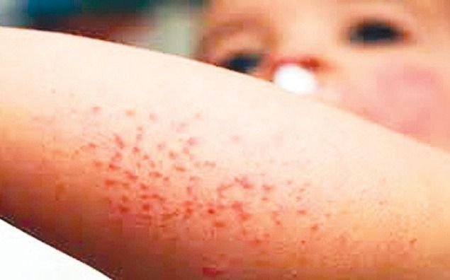 Sarampión, otra pandemia que crece a la sombra del COVID pese a ser prevenible
