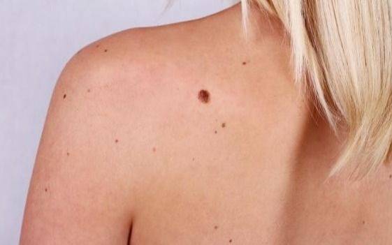Chequeos gratis de lunares en la plaza Moreno