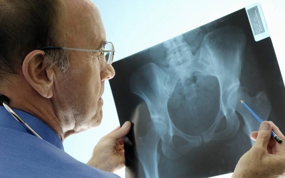 Osteoporosis: provoca 90 fracturas de cadera por día en la Argentina