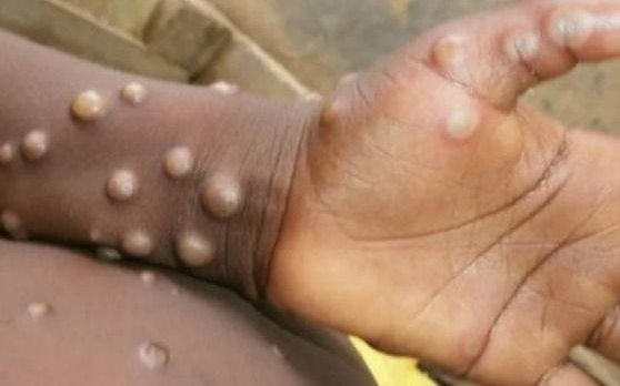 Confirman el tercer caso en el país de viruela símica