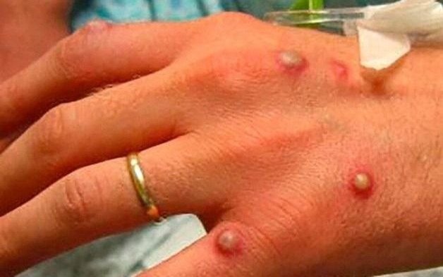 Viruela del mono: un 80% más de casos en una semana