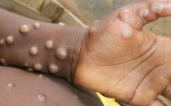 Asocian a la viruela del mono con la miocarditis