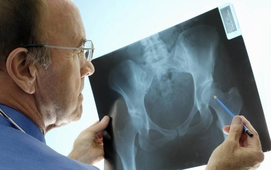 Día Mundial de la Osteoporosis: después de los 50, uno de cada cinco hombres se fractura por esta enfermedad