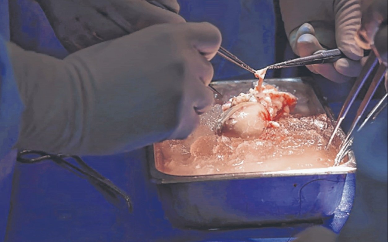 Un trasplante histórico: colocan un riñón de cerdo a un paciente