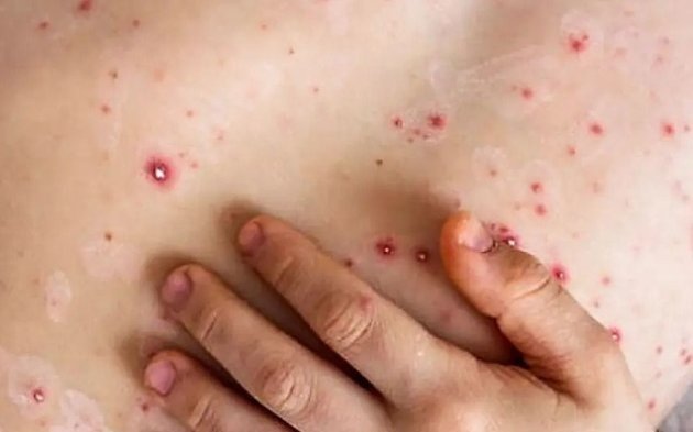 Primer caso autóctono de la viruela del mono en el país