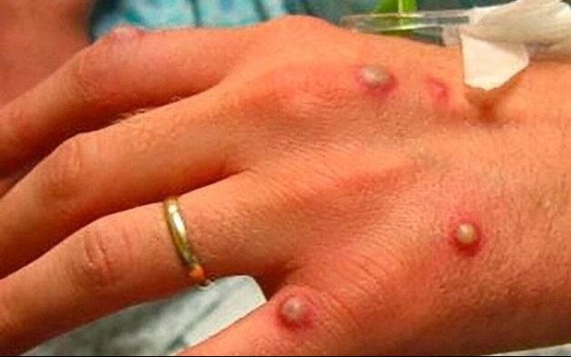 Viruela símica: buscan frenar brotes en seis meses
