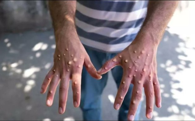 Prueban en animales un fármaco contra el Mpox