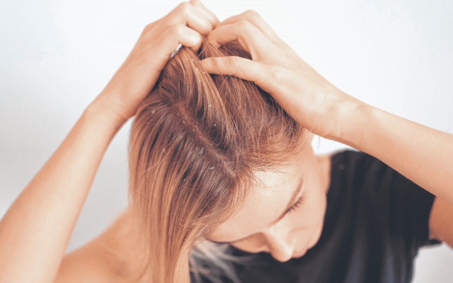 Consejos prácticos para eliminar la caspa del pelo