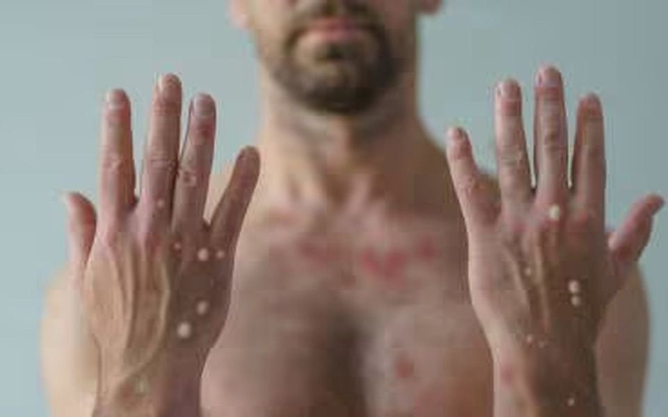 Mpox: la OMS decidió mantener el nivel máximo de alerta