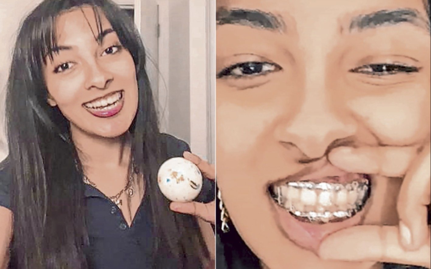 Caramelo 1 Mandíbula 0: una canadiense de 19 años se rompió la quijada al morder un dulce de 7 cm