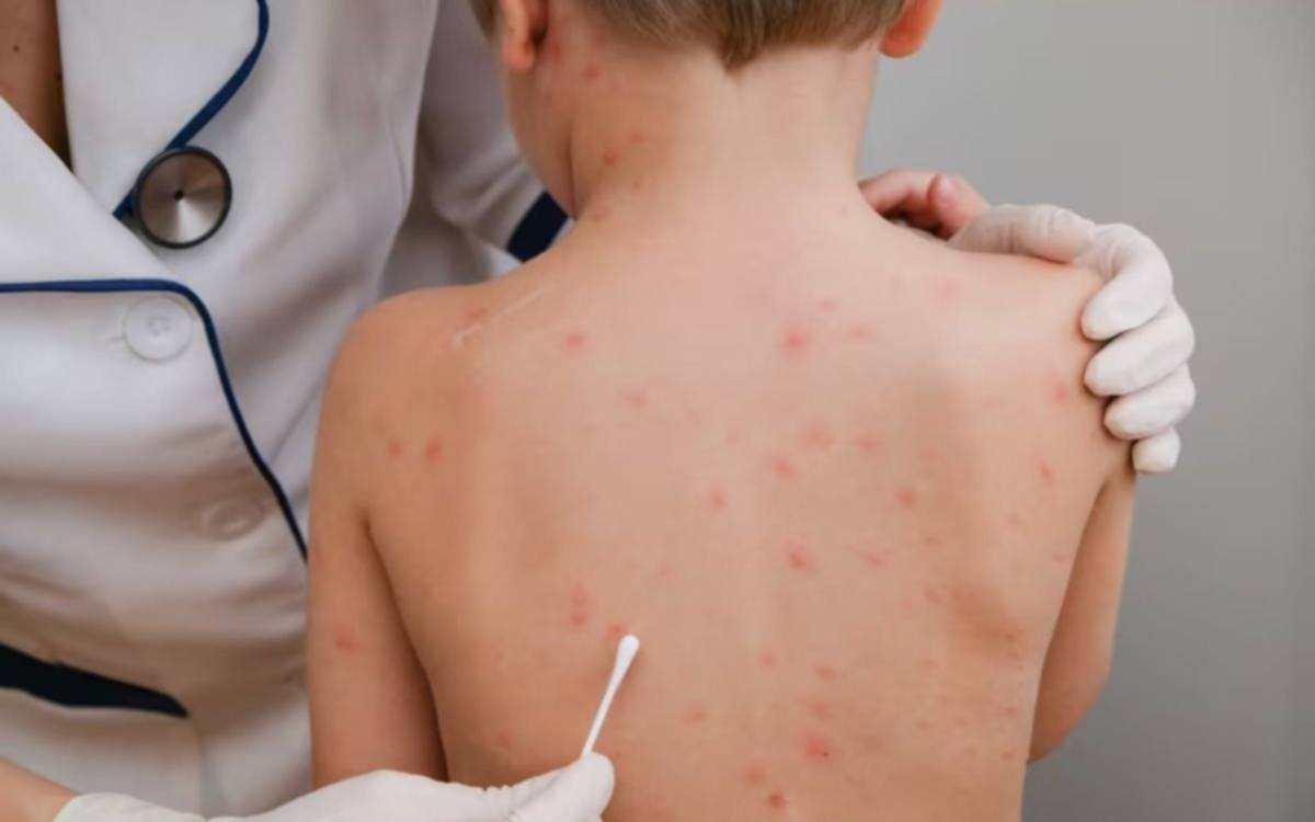 Alerta por sarampión: más de 30 casos en el AMBA