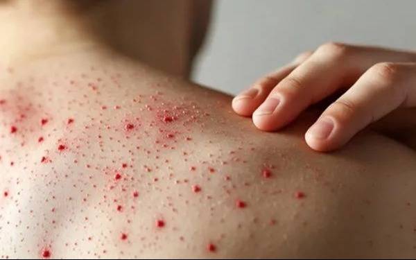 El continente perdió su estatus libre de la enfermedad por su persistencia en Canadá