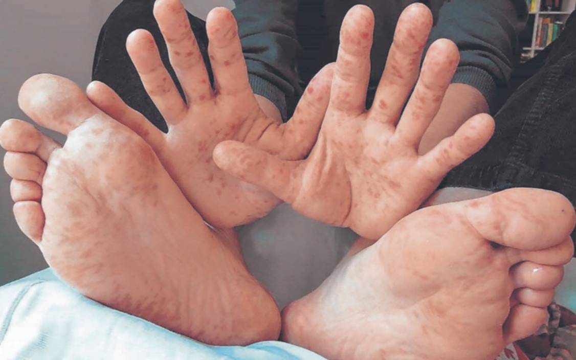 Alerta estacional: resurge la enfermedad de boca, manos y pies