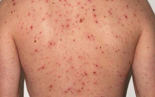 Un caso de sarampión en Entre Ríos reactivó la alerta sanitaria nacional